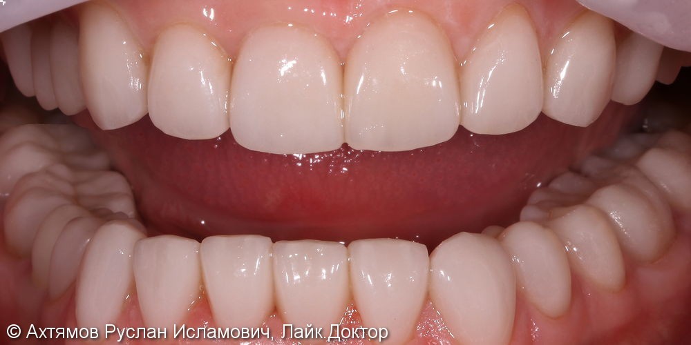Полное восстановление зубных рядов керамическими винирами - фото №7