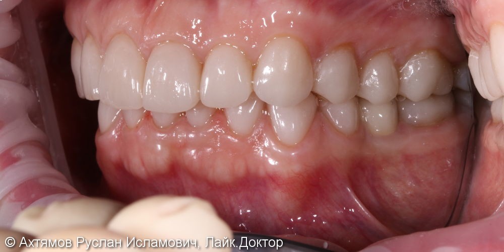 Полное восстановление зубных рядов керамическими винирами - фото №4