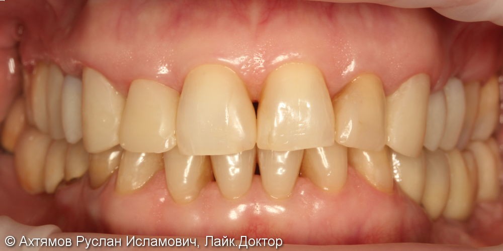 Преображение верхнего зубного ряда, этап тотальной реконструкции - фото №1