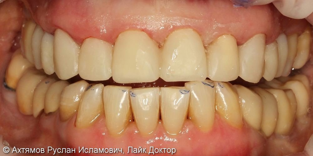 Преображение верхнего зубного ряда, этап тотальной реконструкции - фото №2