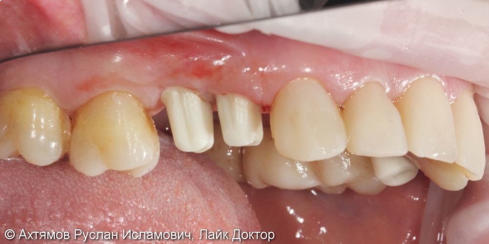 Преображение верхнего зубного ряда, этап тотальной реконструкции - фото №3