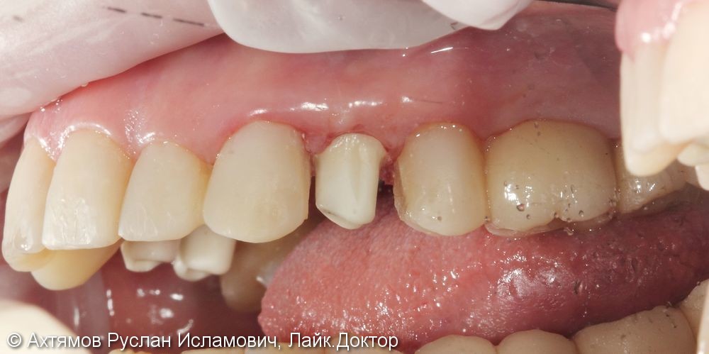 Преображение верхнего зубного ряда, этап тотальной реконструкции - фото №4