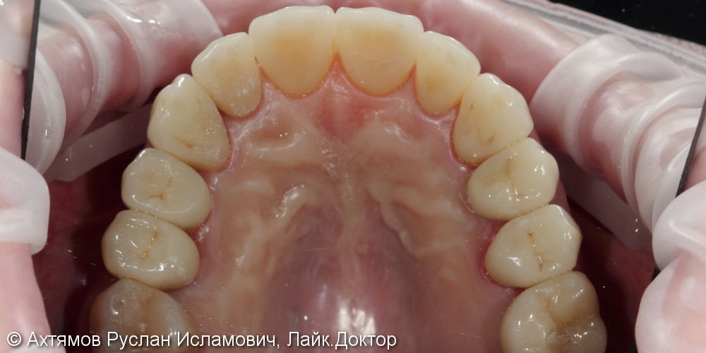 Преображение верхнего зубного ряда, этап тотальной реконструкции - фото №5