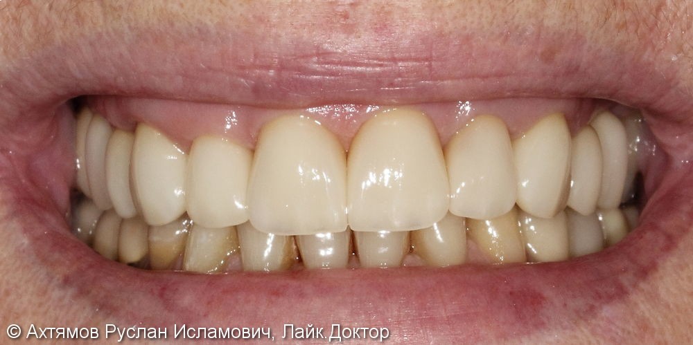 Преображение верхнего зубного ряда, этап тотальной реконструкции - фото №6