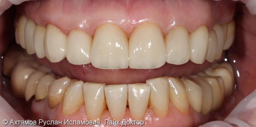 Преображение верхнего зубного ряда, этап тотальной реконструкции - фото №7