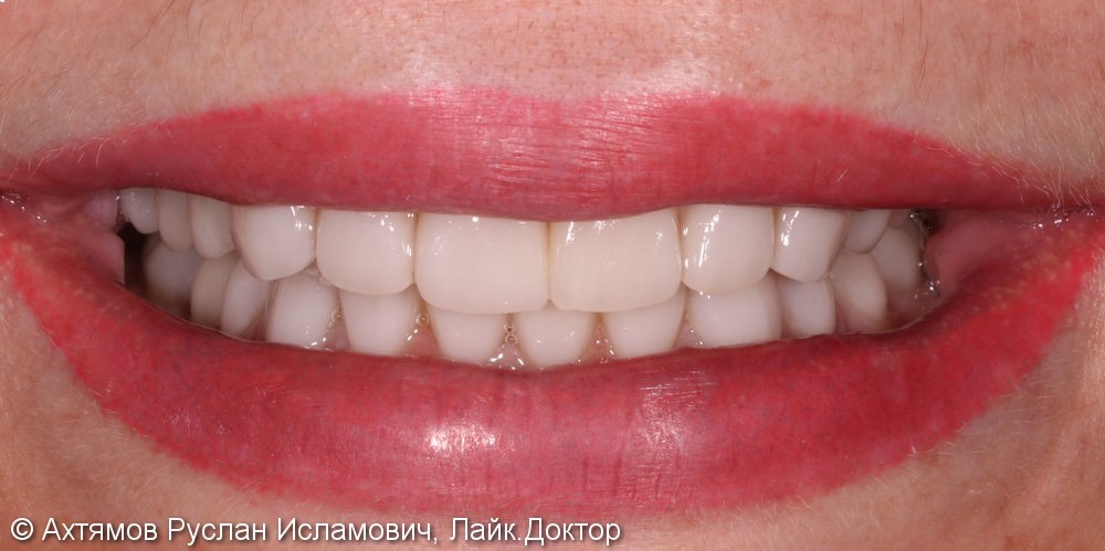 Полное восстановление зубных рядов керамическими винирами - фото №6