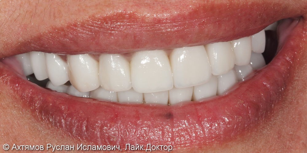Изменение внешнего вида и протезирование боковых отделов зубных рядов - фото №3