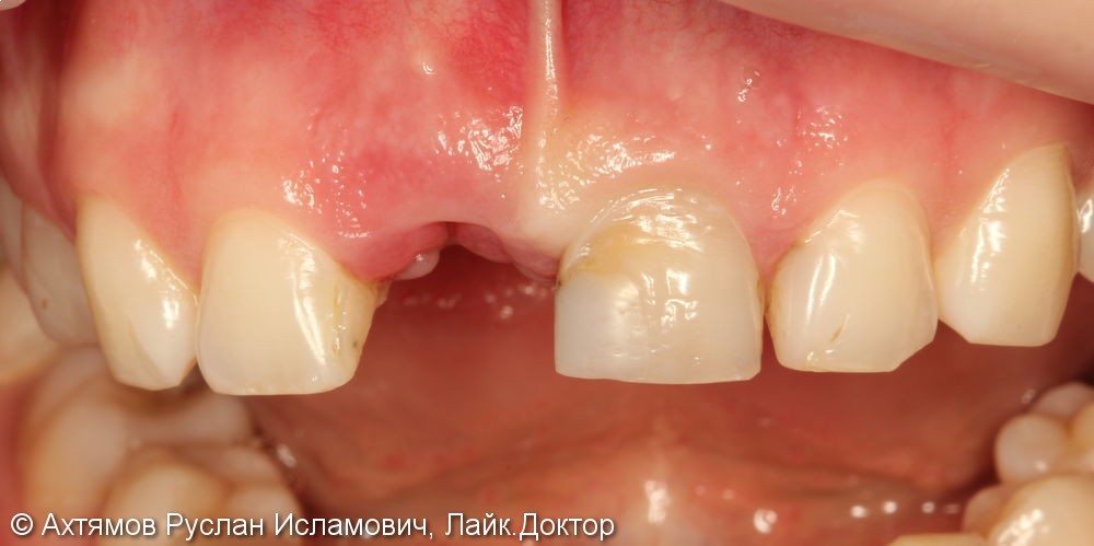 Восстановление двух передних зубов с помощью имплантатов Astra Tech - фото №1