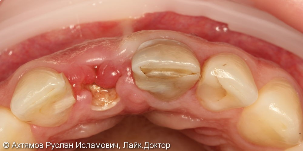 Восстановление двух передних зубов с помощью имплантатов Astra Tech - фото №2