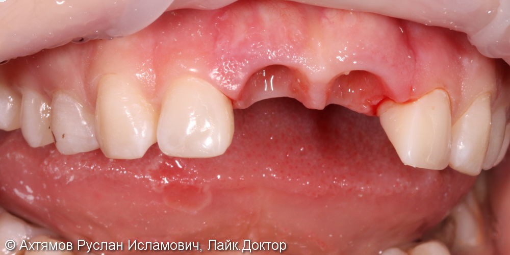 Восстановление двух передних зубов с помощью имплантатов Astra Tech - фото №3