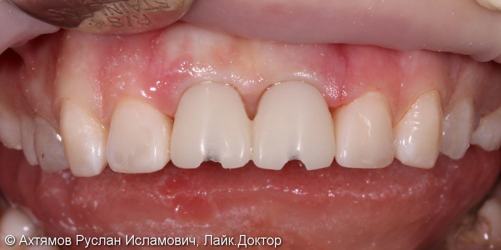 Восстановление двух передних зубов с помощью имплантатов Astra Tech - фото №4