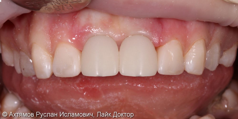 Восстановление двух передних зубов с помощью имплантатов Astra Tech - фото №5