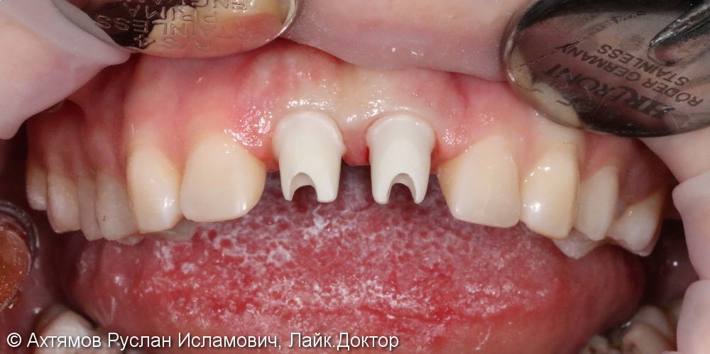 Восстановление двух передних зубов с помощью имплантатов Astra Tech - фото №6