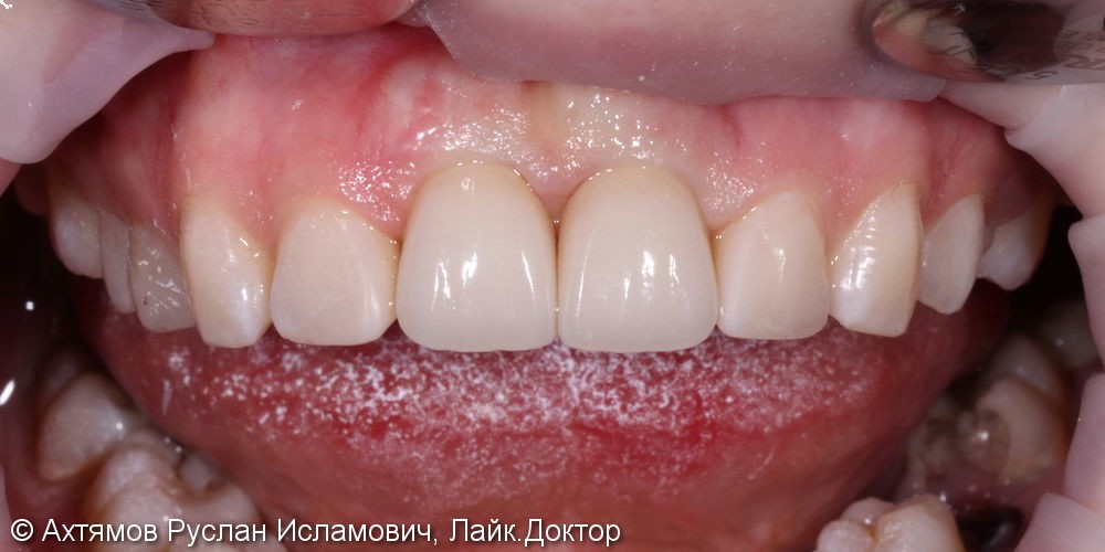 Восстановление двух передних зубов с помощью имплантатов Astra Tech - фото №7