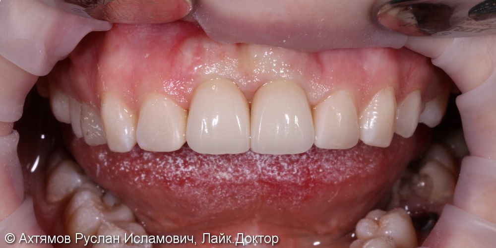 Восстановление двух передних зубов с помощью имплантатов Astra Tech - фото №8
