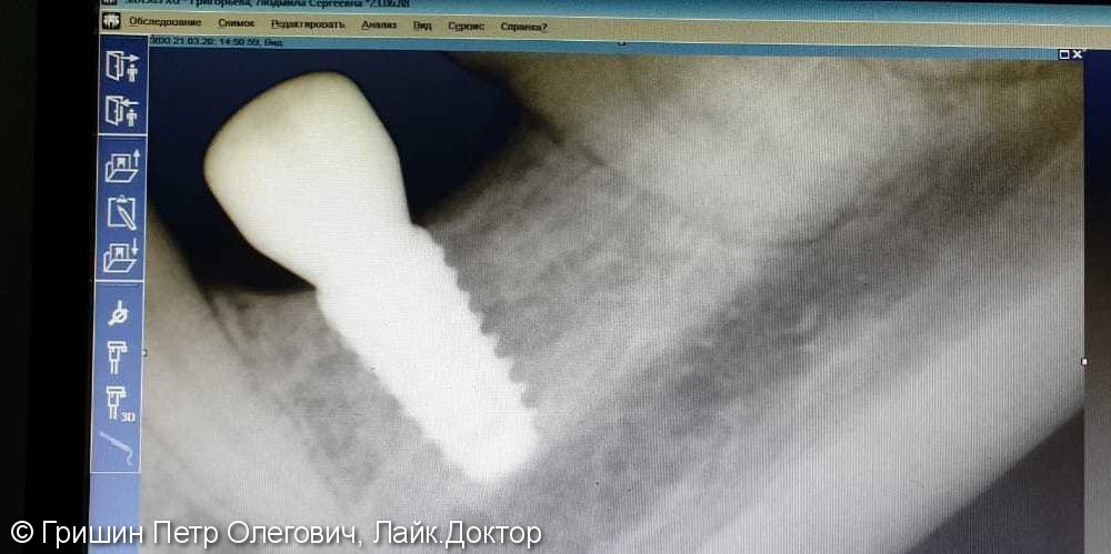 Имплантация в области 36 зуба с установкой формирователя - фото №1