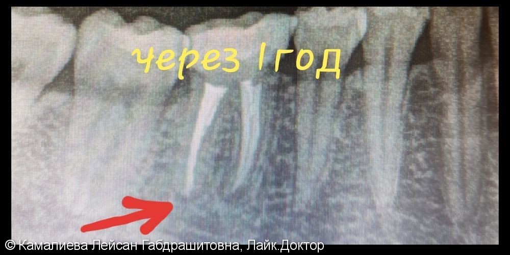 Фото плохих зубов после лечения thumbnail