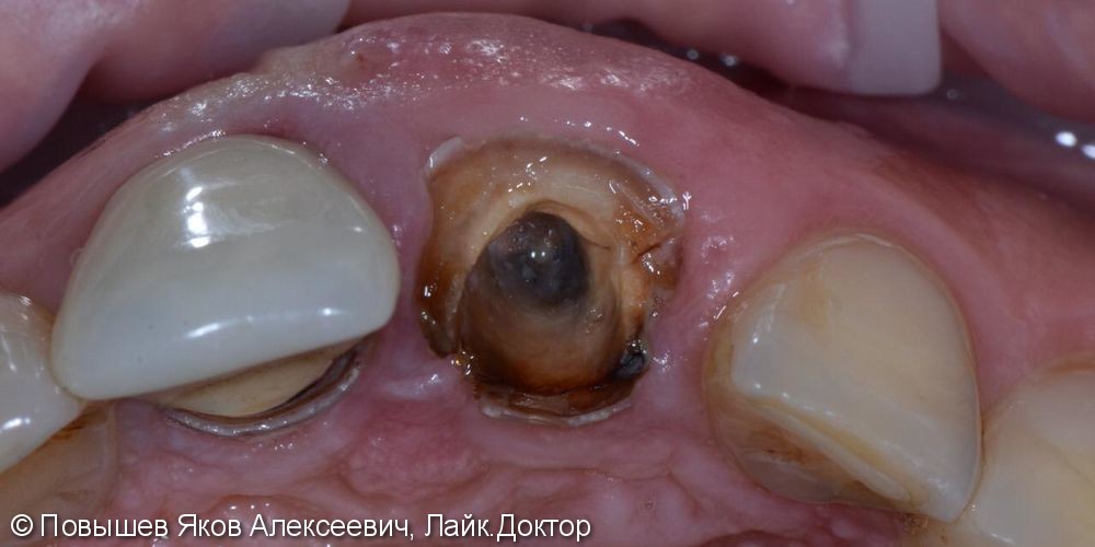 Удаление зуба, восстановление вестибулярной кортикальной пластины трансплантатом с бугра верхней челюсти, временная коронка. Пластика мягких тканей - фото №1