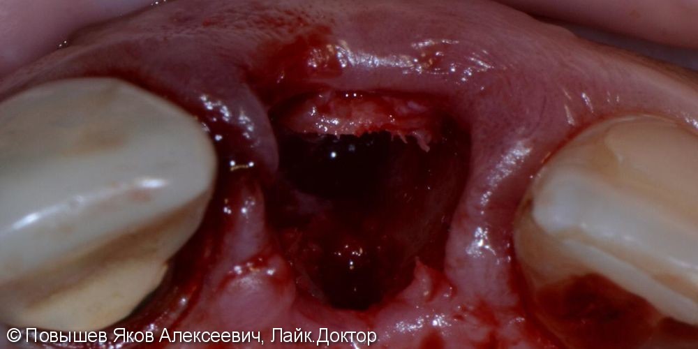 Удаление зуба, восстановление вестибулярной кортикальной пластины трансплантатом с бугра верхней челюсти, временная коронка. Пластика мягких тканей - фото №2