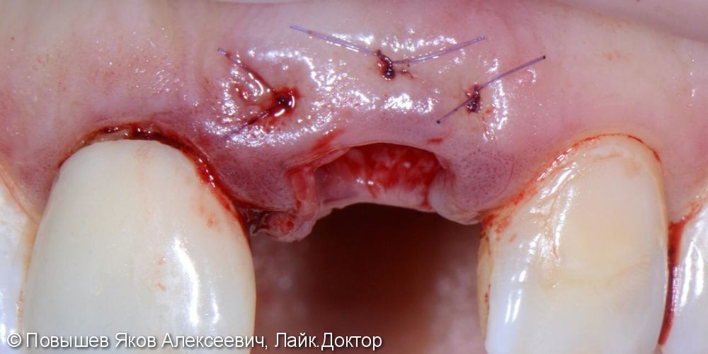 Удаление зуба, восстановление вестибулярной кортикальной пластины трансплантатом с бугра верхней челюсти, временная коронка. Пластика мягких тканей - фото №4