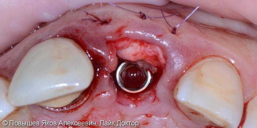 Удаление зуба, восстановление вестибулярной кортикальной пластины трансплантатом с бугра верхней челюсти, временная коронка. Пластика мягких тканей - фото №5