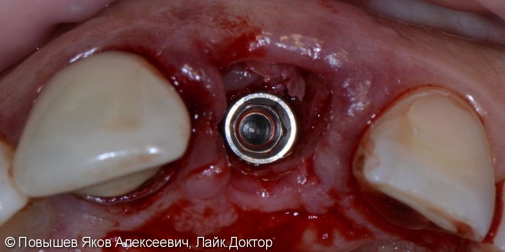 Удаление зуба, восстановление вестибулярной кортикальной пластины трансплантатом с бугра верхней челюсти, временная коронка. Пластика мягких тканей - фото №6