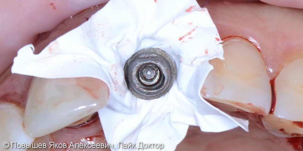 Удаление зуба, восстановление вестибулярной кортикальной пластины трансплантатом с бугра верхней челюсти, временная коронка. Пластика мягких тканей - фото №7