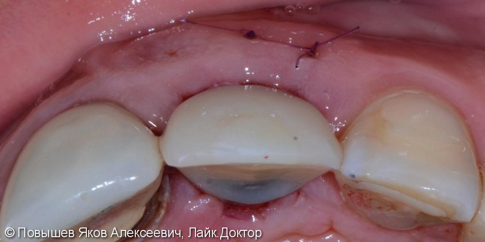 Удаление зуба, восстановление вестибулярной кортикальной пластины трансплантатом с бугра верхней челюсти, временная коронка. Пластика мягких тканей - фото №8