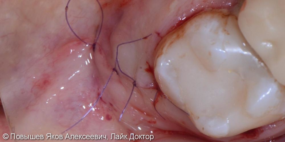 Удаление зуба, восстановление вестибулярной кортикальной пластины трансплантатом с бугра верхней челюсти, временная коронка. Пластика мягких тканей - фото №9