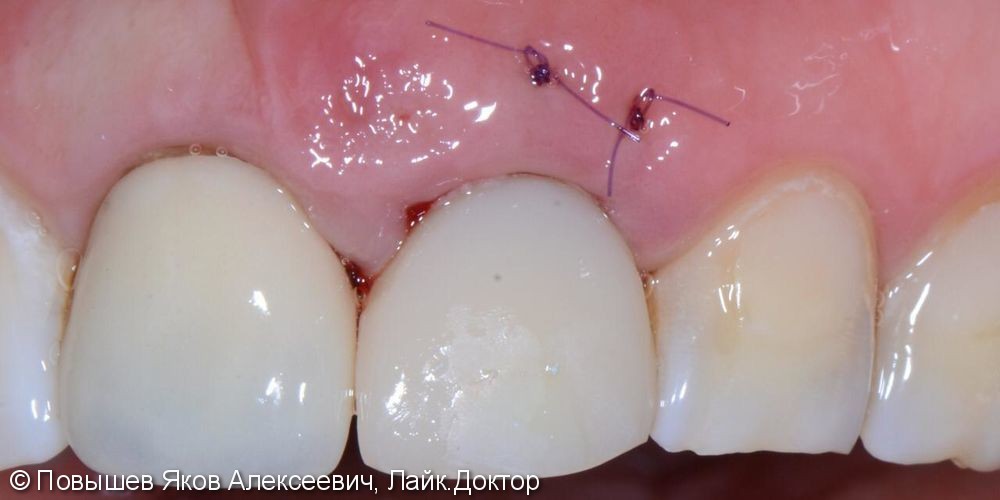 Удаление зуба, восстановление вестибулярной кортикальной пластины трансплантатом с бугра верхней челюсти, временная коронка. Пластика мягких тканей - фото №10