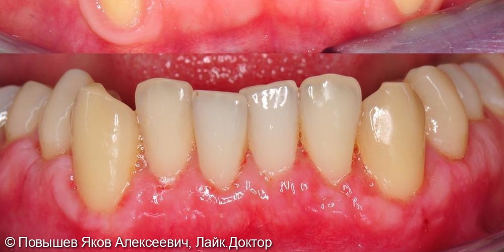 Рецессия десны зубов нижней челюсти - фото №2