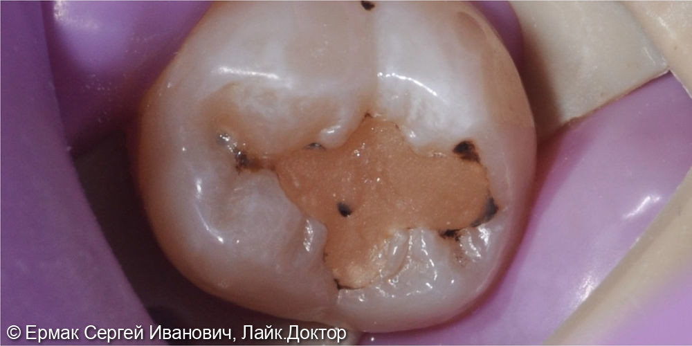 Лечение чуствительности и вторичного кариеса - фото №1
