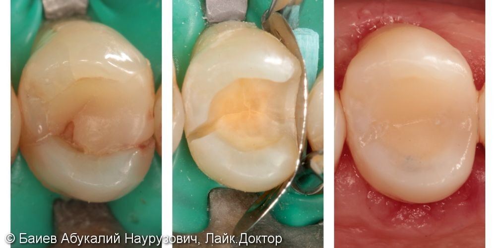 Лечение кариеса, жалобы на застревание пищи между зубами, до и после - фото №1
