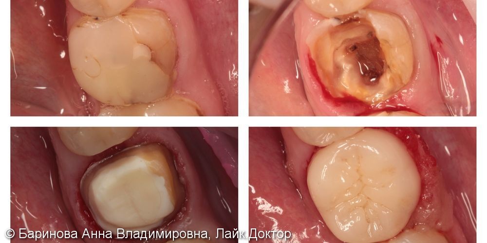 Перелечивание каналов в корне зуба и протезирование керамической коронкой E.max - фото №1