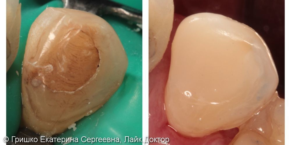 Реставрация 23 зуба под микроскопом, результат до и после - фото №1