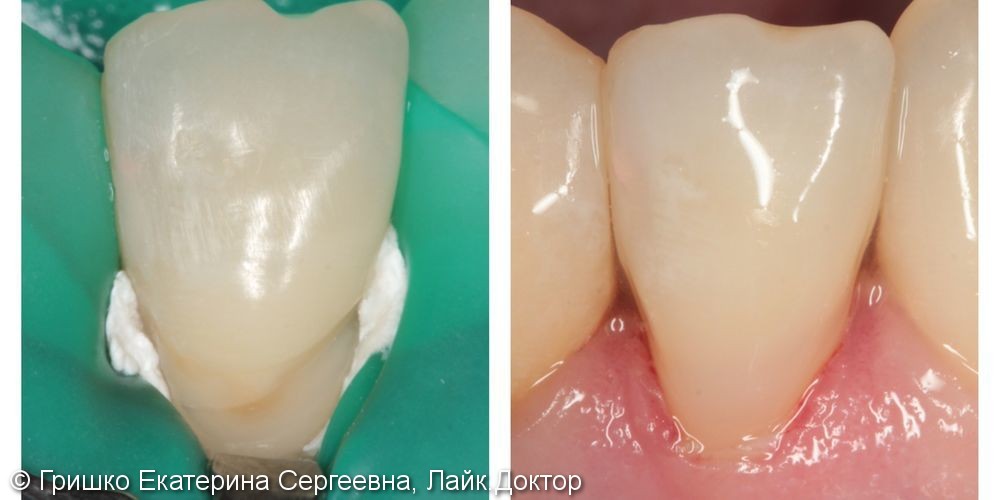 Лечение клиновидного дефекта зуба, результат до и после - фото №1