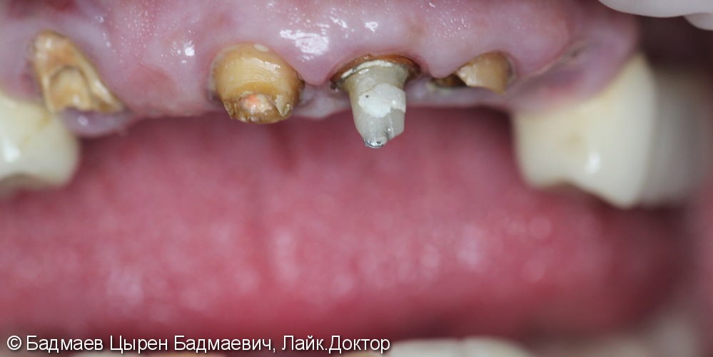 Имплантация верхних зубов, операция синус-лифтинг, результат до и после - фото №1