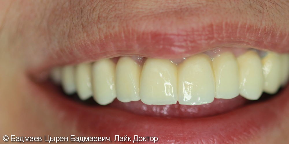 Имплантация верхних зубов, операция синус-лифтинг, результат до и после - фото №2