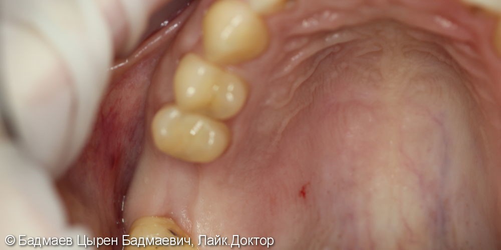 Имплантация зуба 2.6, синус-лифтинг, фото до и после - фото №1