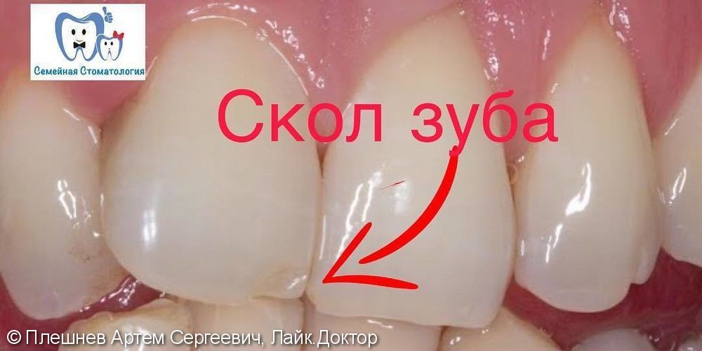 Восстановление скола на зубе - фото №1