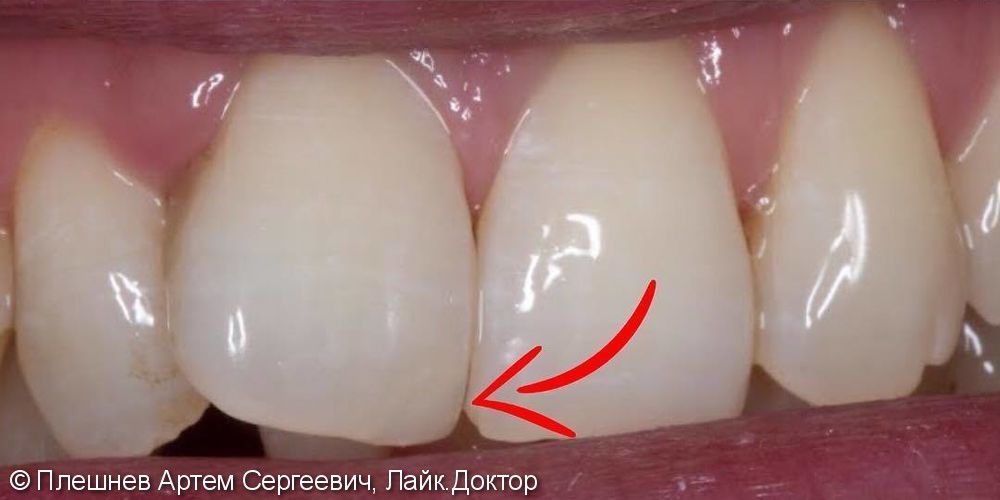 Восстановление скола на зубе - фото №2