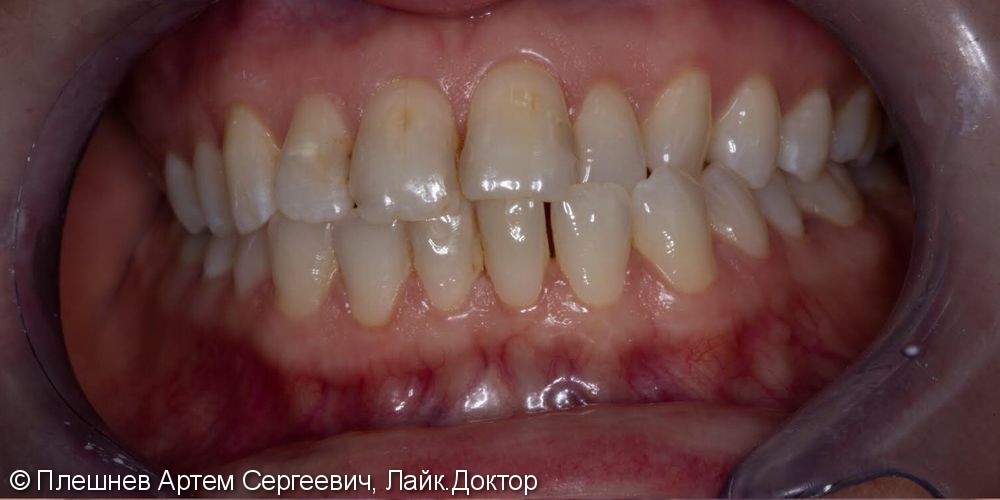 Результат отбеливания зубов - фото №1