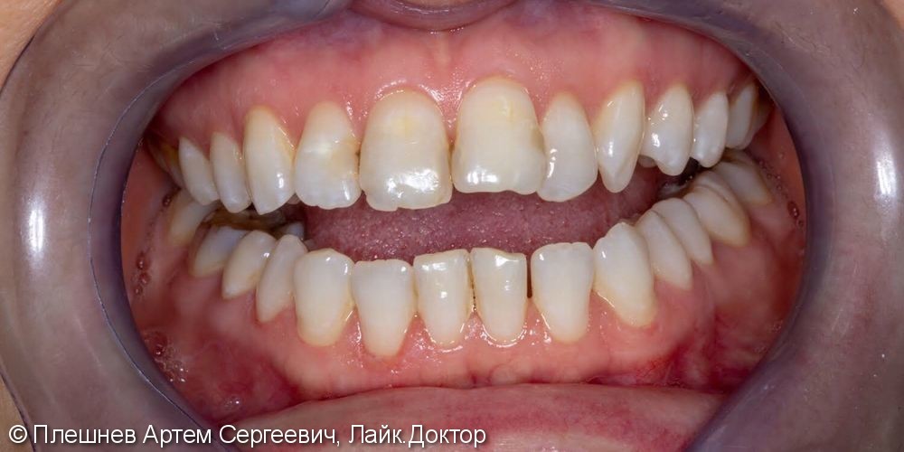 Результат отбеливания зубов - фото №2