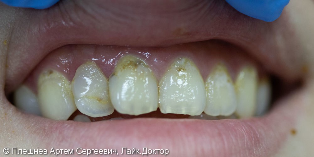 лечение эрозии эмали 11 и 21 зуб, замена пломбы 12 зуба - фото №1