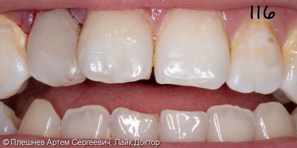 лечение эрозии эмали 11 и 21 зуб, замена пломбы 12 зуба - фото №2