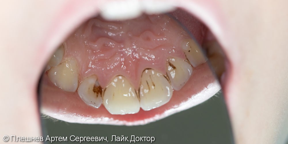 профессиональная гигиена рта(пациент 15 лет) - фото №1