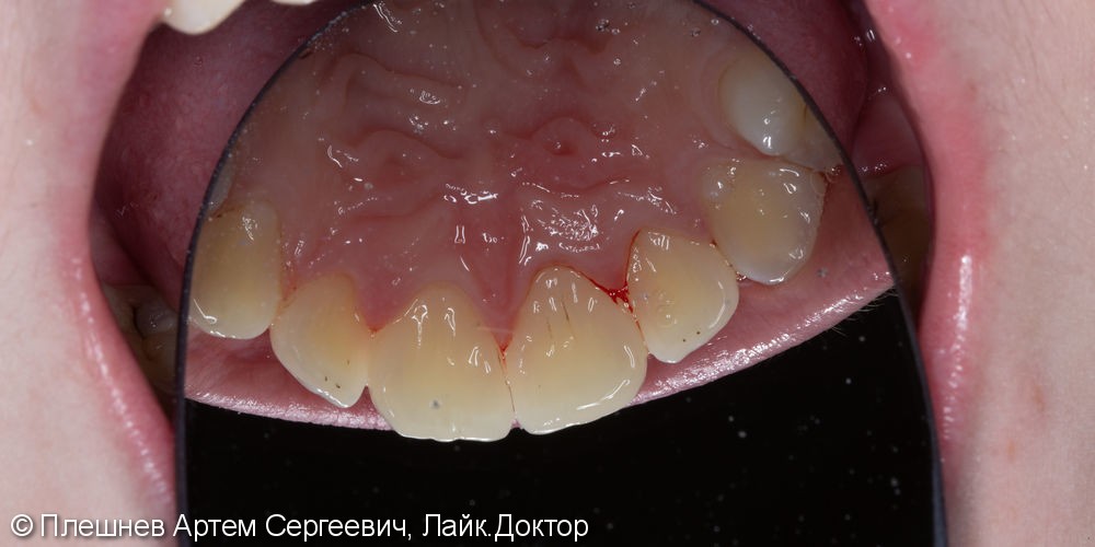 профессиональная гигиена рта(пациент 15 лет) - фото №2