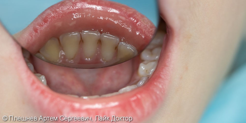 профессиональная гигиена рта(пациент 15 лет) - фото №3