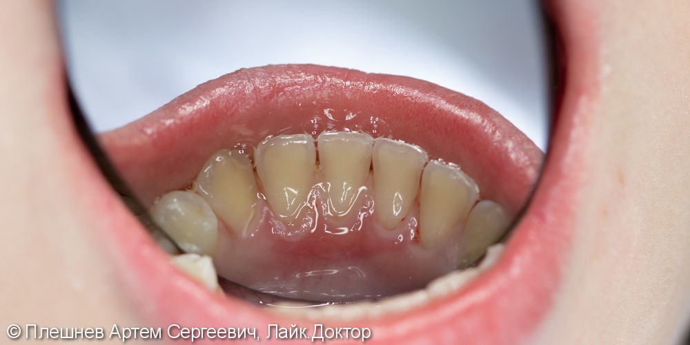 профессиональная гигиена рта(пациент 15 лет) - фото №4