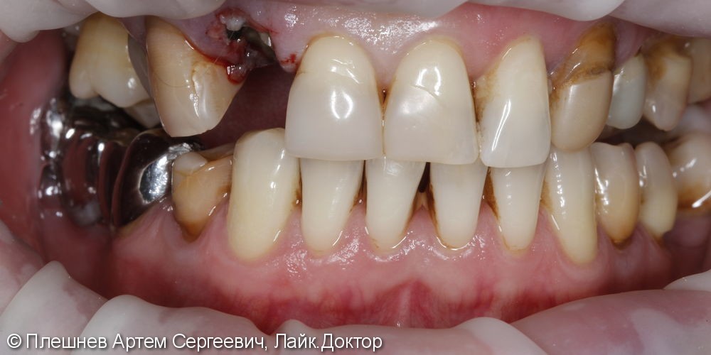 Восстановление 12 зуба - фото №1